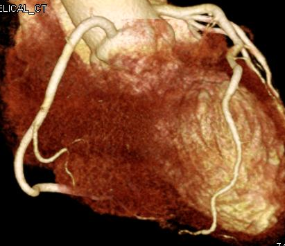 冠動脈の画像1