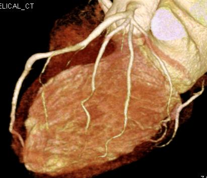 冠動脈の画像2