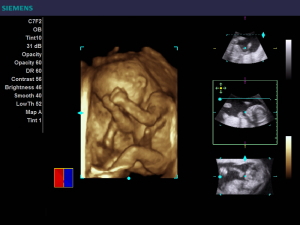 胎児の3D画像