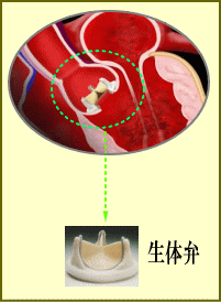 大動脈弁狭窄症の人工弁を使用した治療方法例