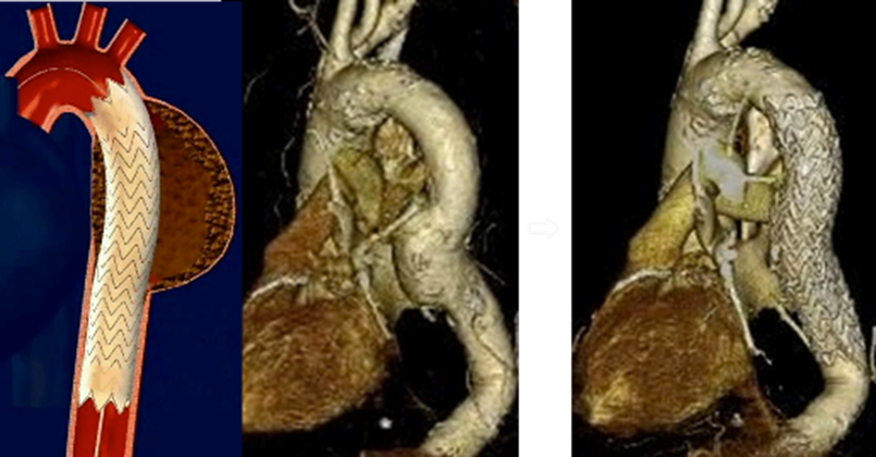 胸部大動脈瘤に対するステントグラフト治療例