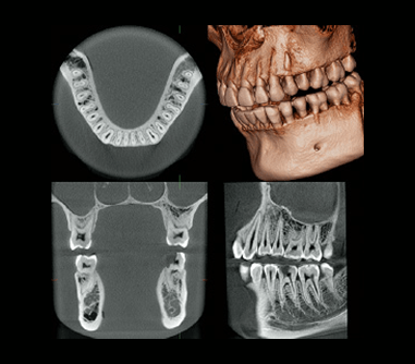 歯科用X線CT写真